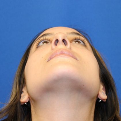 Rhinoplasty Before & After Patient #1555