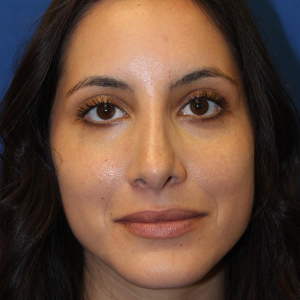 Rhinoplasty Before & After Patient #1555