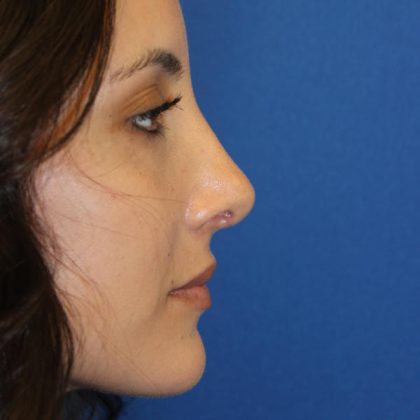 Rhinoplasty Before & After Patient #1555