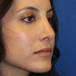 Rhinoplasty Before & After Patient #1555