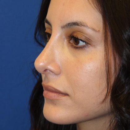 Rhinoplasty Before & After Patient #1555