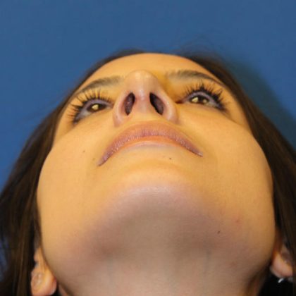 Rhinoplasty Before & After Patient #1555