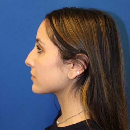 Rhinoplasty Before & After Patient #1555