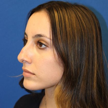 Rhinoplasty Before & After Patient #1555