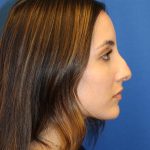 Rhinoplasty Before & After Patient #1555