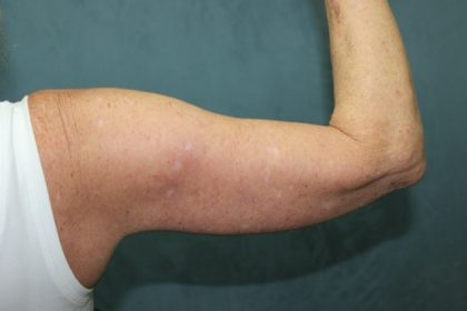 Arm Lift Before & After Patient #89