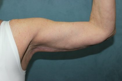 Arm Lift Before & After Patient #89