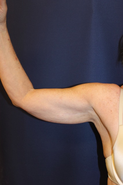 Arm Lift Before & After Patient #89