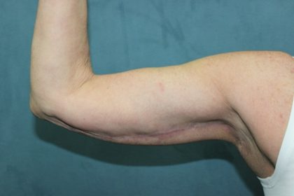 Arm Lift Before & After Patient #89