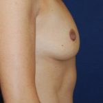Breast Augmentation Before & After Patient #201