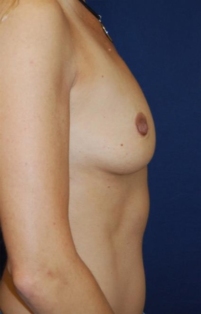 Breast Augmentation Before & After Patient #201