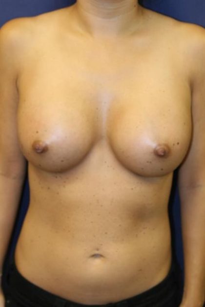 Breast Augmentation Before & After Patient #221