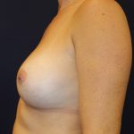 Breast Augmentation Before & After Patient #247