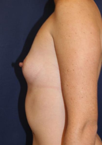 Breast Augmentation Before & After Patient #189