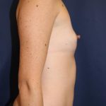 Breast Augmentation Before & After Patient #189