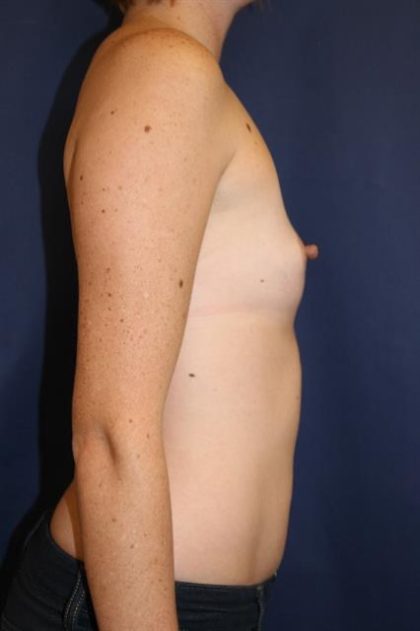 Breast Augmentation Before & After Patient #189