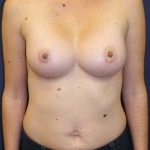 Breast Augmentation Before & After Patient #189