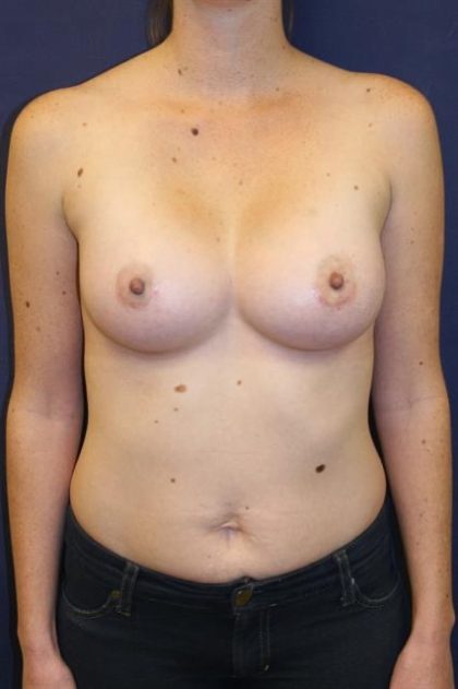 Breast Augmentation Before & After Patient #189