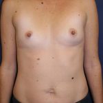 Breast Augmentation Before & After Patient #189