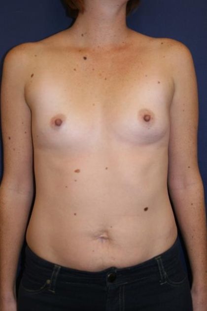 Breast Augmentation Before & After Patient #189