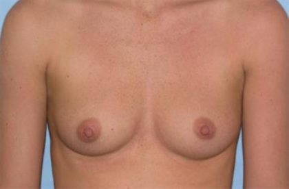 Breast Augmentation Before & After Patient #211