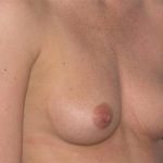 Breast Augmentation Before & After Patient #211