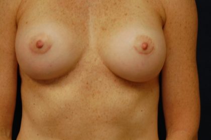 Breast Augmentation Before & After Patient #181