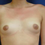 Breast Augmentation Before & After Patient #229