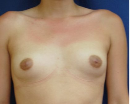 Breast Augmentation Before & After Patient #229