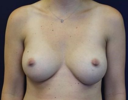 Breast Augmentation Before & After Patient #235