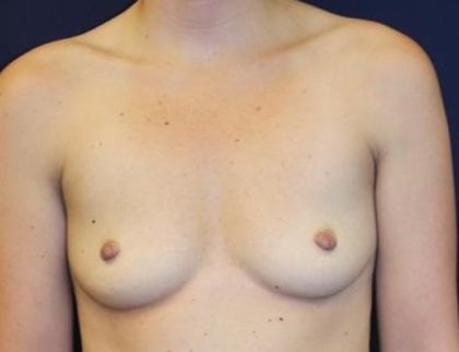 Breast Augmentation Before & After Patient #235