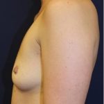 Breast Augmentation Before & After Patient #235