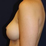 Breast Augmentation Before & After Patient #235