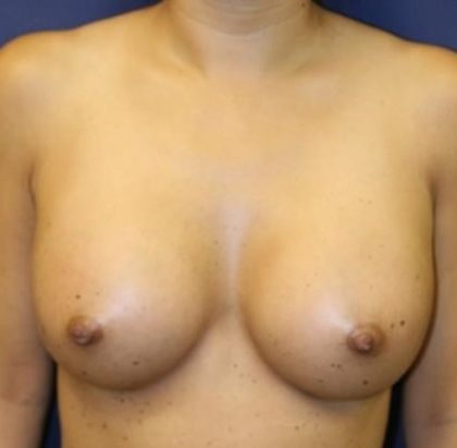 Breast Augmentation Before & After Patient #242