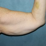 Arm Lift Before & After Patient #84