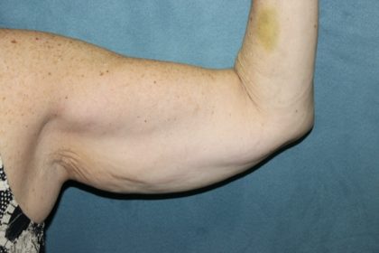 Arm Lift Before & After Patient #84
