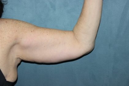 Arm Lift Before & After Patient #84