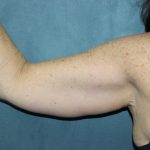 Arm Lift Before & After Patient #84