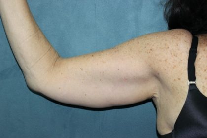 Arm Lift Before & After Patient #84