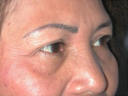 Blepharoplasty Before & After Patient #336