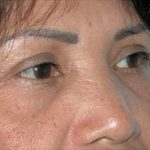 Blepharoplasty Before & After Patient #336