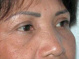 Blepharoplasty Before & After Patient #336