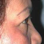 Blepharoplasty Before & After Patient #336