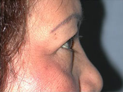 Blepharoplasty Before & After Patient #336