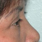 Blepharoplasty Before & After Patient #336