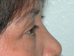 Blepharoplasty Before & After Patient #336