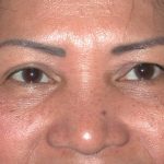 Blepharoplasty Before & After Patient #336