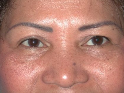 Blepharoplasty Before & After Patient #336