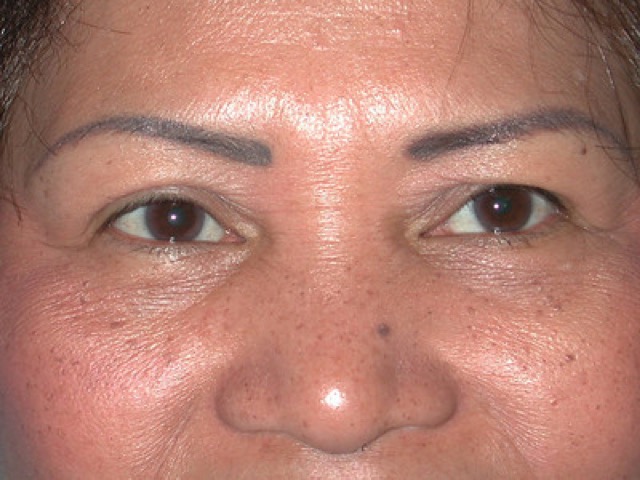 Blepharoplasty Before & After Patient #336