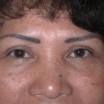 Blepharoplasty Before & After Patient #336